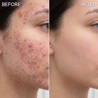 SKIN PROBLEMS & ACNE RELIEF